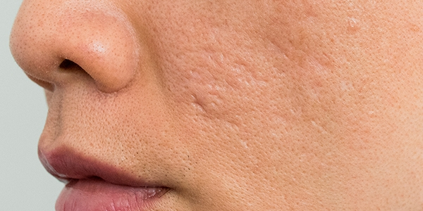Perfil de una mujer con acné visible en su piel.